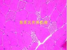 《脂质沉积性肌病》课件