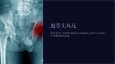 《股骨头坏死》课件