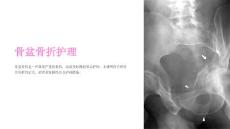 《骨盆骨折护理》课件