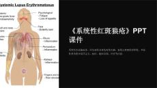 《系统性红斑狼疮》课件