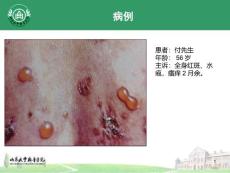 大疱性类天疱疮.ppt