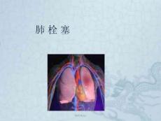 肺栓塞课件