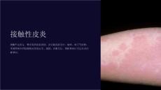 《接触性皮炎》课件