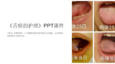 《舌癌的护理》课件