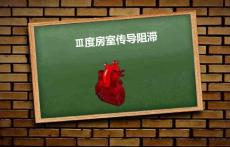 三度房室传导阻滞