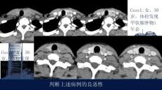 甲狀腺良性結節影像診斷