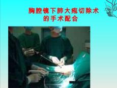 胸腔镜肺大疱切除