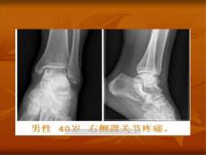 骨内腱鞘囊肿命名课件