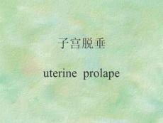 子宫脱垂