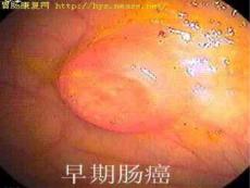 结肠癌结肠癌.ppt