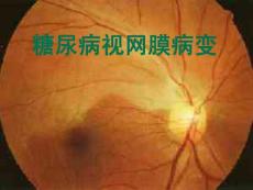 糖尿病视网膜病变课件