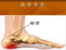 跟骨骨折护理课件