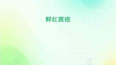 鲜红斑痣