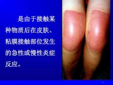 接触性皮炎课件.ppt