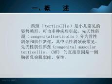 齐鲁医学先天性肌性斜颈的康复概述.pptx