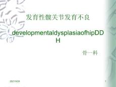 发育性髋关节发育不良