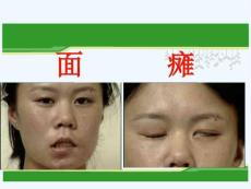 中医面瘫