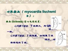 心肌缺血心电图通用课件