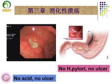 消化性溃疡