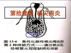 根尖周炎ppt