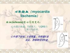 心肌缺血心电图