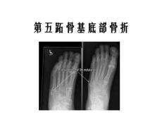 第五跖骨基底部骨折