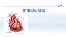 扩张性心肌病