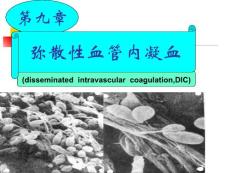 -弥散性血管内凝血课件
