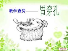 胃穿孔初稿课件