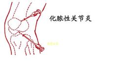 化脓性关节炎培训课件