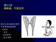 喉阻塞专题培训培训课件