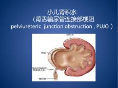 小儿肾积水【22页】