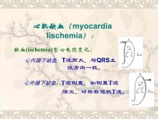 心肌缺血心电图培训课件