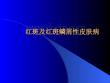 红斑和红斑鳞性皮肤病PPT培训课件