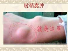 腱鞘囊肿培训课件