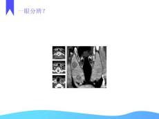 甲状腺乳头状癌CT征象