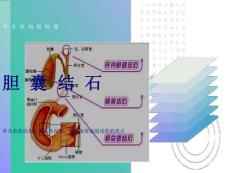 胆囊结石护理PPT