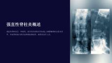 《强直性脊柱炎》课件