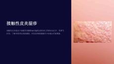 《接触性皮炎湿疹》课件