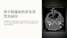 鼻中隔偏曲护理教学课件