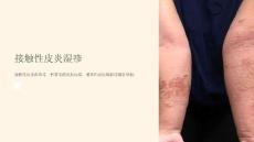 《接触性皮炎湿疹》课件