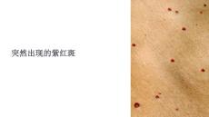 《突然出现的紫红斑》课件