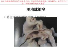 主动脉缩窄专题知识宣教培训课件