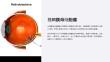 《视网膜母细胞瘤》课件