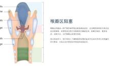 《喉瓣区阻塞》课件