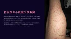 《特发性血小板减少性紫癜》课件