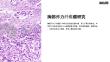 《胸部弹力纤维瘤》课件