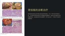 《肾结核的诊断治疗》课件