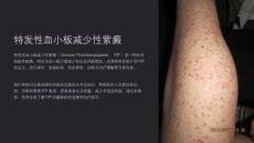 《特发性血小板减少性紫癜》课件