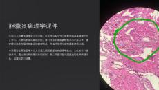 《胆囊炎病理》课件